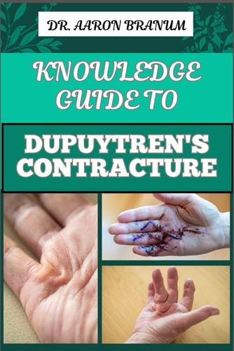 Knowledge Guide to Dupuytren's Contracture Comprehensive Manual To Symptoms, Treatments, And Preventative Care For Hand Health And Mobility