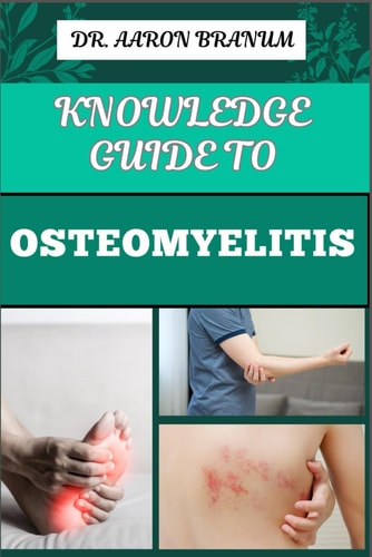 Knowledge Guide to Osteomyelitis Essential Manual To Diagnosis, Treatment, Prevention, and Advanced Therapies for Bone Infection Management