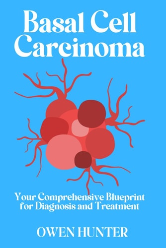 Basal Cell Carcinoma Your Comprehensive Blueprint for Diagnosis and Treatment