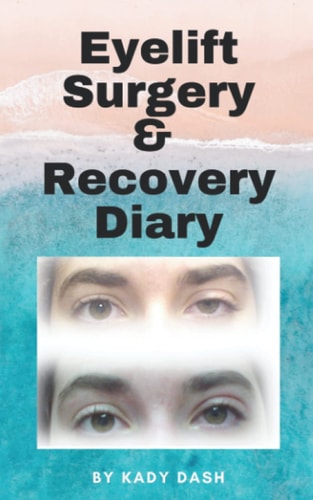 Eyelift Surgery and Recovery Diary Ptosis, Eyelifts, Punctal Plugs, and Dry Eyes