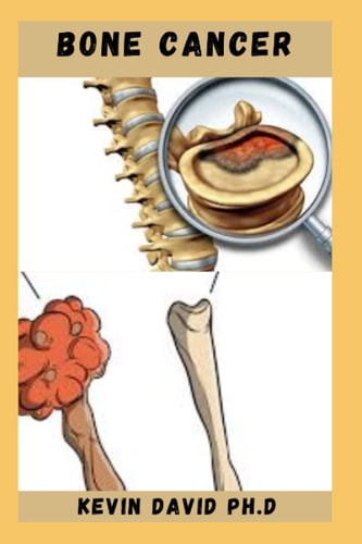Bone Cancer Easy To Prepare Calcium Rich Recipes To Heal Bone Cancer Includes How To Get Started