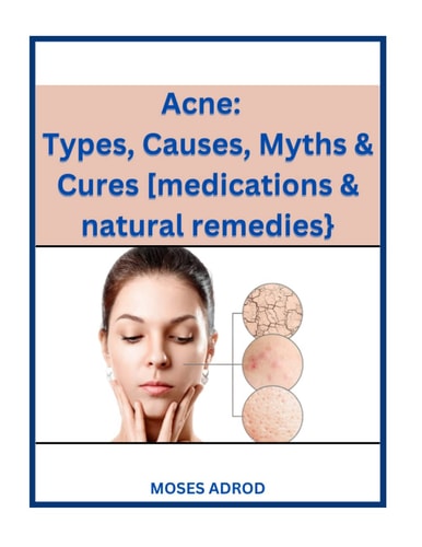 Acne Types, Causes, Myths & Cures [medications & Natural Remedies}.