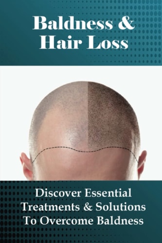 Baldness & Hair Loss Discover Essential Treatments & Solutions To Overcome Baldness: How To Prevent Hair Loss For Guys