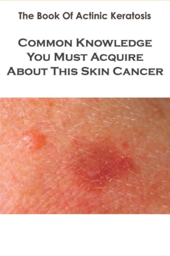 The Book Of Actinic Keratosis_ Common Knowledge You Must Acquire About This Skin Cancer Skin Cancer Books