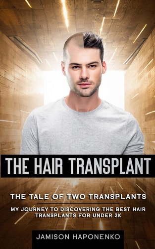 The Hair Transplant The Tale Of Two Transplants My Journey to Discovering the Best Transplants for Under 2k
