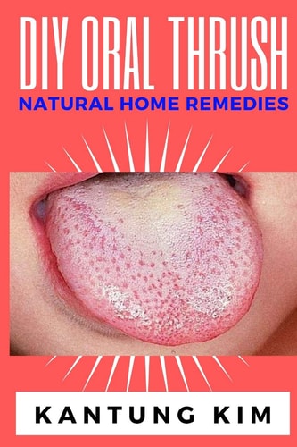 DIY Oral Thrush Natural Home Remedies The Effective Step By Step Guide To Permanently End Oral Thrush