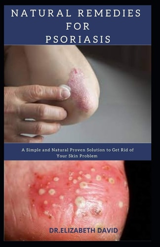 Natural Remedies for Psoriasis A Simple and Natural Proven Solution to Get Rid of Your Skin Problem: Dermatitis, Eczema, Psoriasis & Rosacea and Others