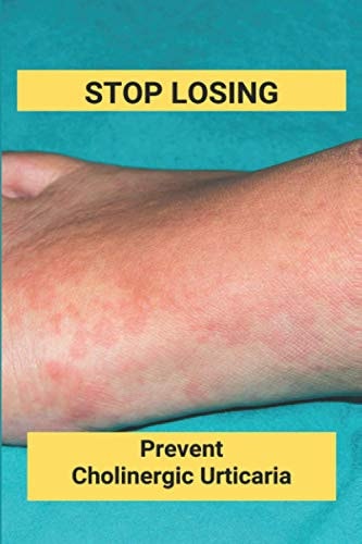 Stop Losing Prevent Cholinergic Urticaria: Losing Itchy Hair
