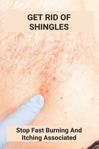 Get Rid Of Shingles Stop Fast Burning And Itching Associated: Shingles On Face Treatment