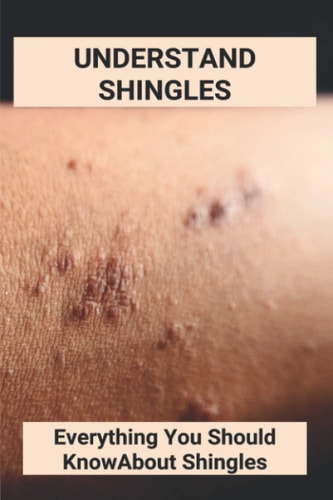 Understand Shingles Everything You Should Know About Shingles: Shingles Topical Treatment