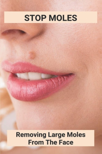 Stop Moles Removing Large Moles From The Face: Surefire Way To Get Rid Of Moles
