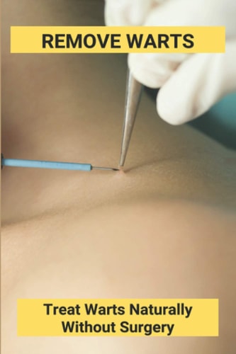 Remove Warts Treat Warts Naturally Without Surgery: Boost Immune System To Get Rid Of Warts