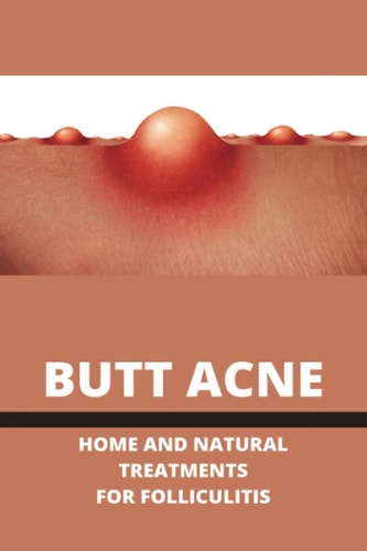 Butt Acne Home And Natural Treatments For Folliculitis: Barber'S Itch Home Remedies