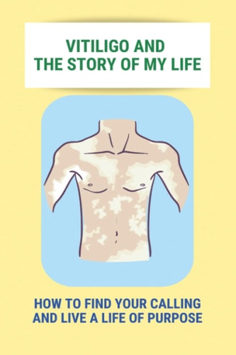 Vitiligo And The Story Of My Life How To Find Your Calling And Live A Life Of Purpose: Vitiligo Social Stigma