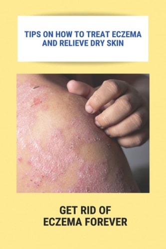 Tips On How To Treat Eczema And Relieve Dry Skin Get Rid Of Eczema Forever: Overcome Eczema