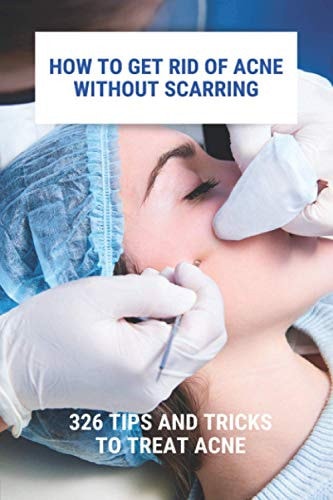 How To Get Rid Of Acne Without Scarring 326 Tips And Tricks To Treat Acne: Natural Pimples Cure
