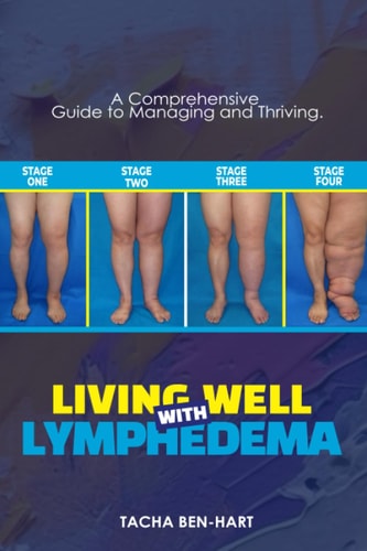 Living Well with Lymphedema A Comprehensive Guide to Managing and Thriving
