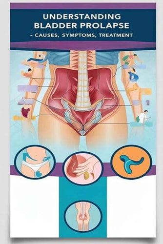 Understanding Bladder Prolapse - Causes, Symptoms, Treatment Bladder Prolapse Happens when Your Bladder Pushes Through Your Pelvic Floor and Into Your Vagina. It is Treatable, Especially in Early Stages.