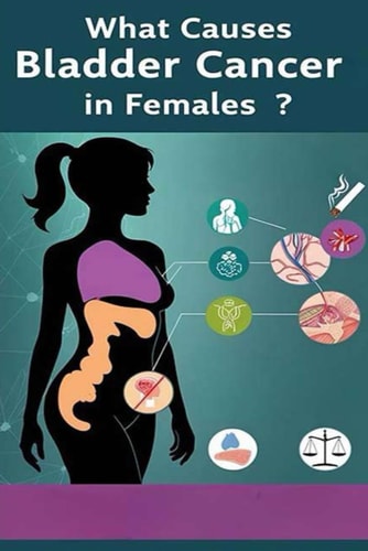 What Causes Bladder Cancer in Females? There are Many Potential Causes Bladder Cancer of in Females from Smoking to Chemical Exposure. Early Signs of Bladder Cancer Include Blood in the Urine.