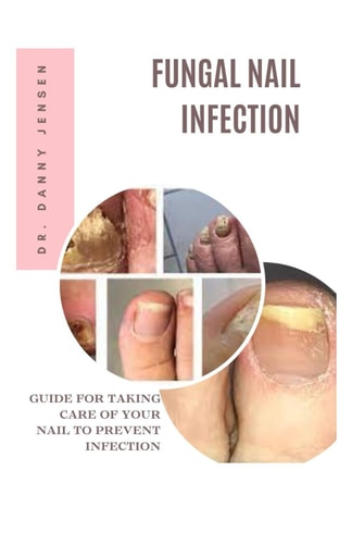 Fungal Nail Infection Guide for Taking Care of Your Nail to Prevent Infection