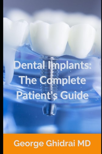 Dental Implants The Complete Patient's Guide