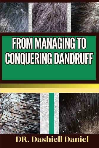 From Managing to Conquering Dandruff Expert Guide To Understanding Causes, Identifying Symptoms, And Implementing Effective Treatments For A Scalp-Soothing Journey To Healthy Living