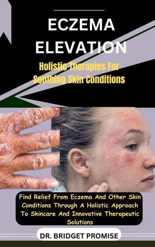 Eczema Elevation Holistic Therapies For Soothing Skin Conditions: Find Relief From Eczema And Other Skin Conditions Through A Holistic Approach To Skincare And Innovative Therapeutic Solutions