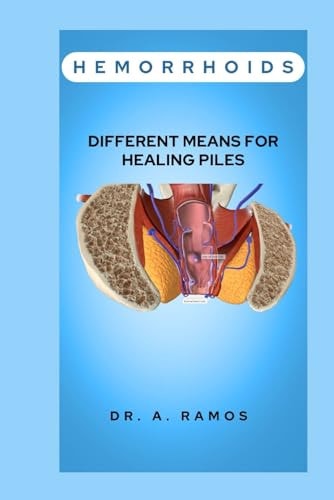 Hemorrhoids Different Means for Healing Piles