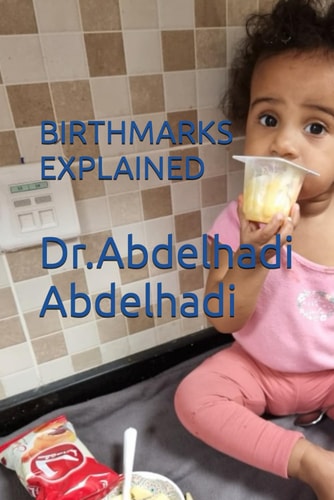 Birthmarks Explained