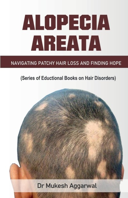 Alopecia Areata